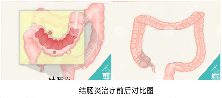 福州肛肠医院 福州医博肛肠医院 福州看痔疮的医院 福州肛瘘医院 福州肛裂医院 福州肠炎医院