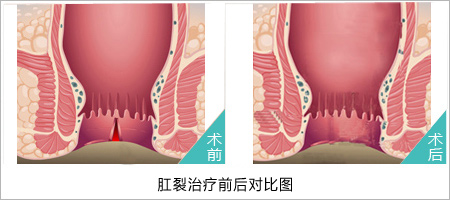 福州肛肠医院 福州医博肛肠医院 福州看痔疮的医院 福州肛瘘医院 福州肛裂医院 福州肠炎医院