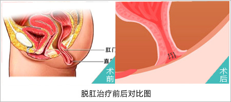 福州肛肠医院 福州医博肛肠医院 福州看痔疮的医院 福州肛瘘医院 福州肛裂医院 福州肠炎医院