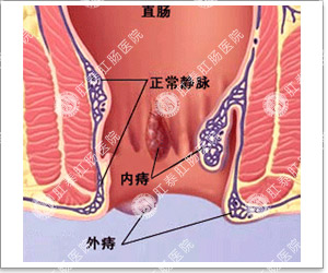 福州肛肠医院 福州医博肛肠医院 福州看痔疮的医院 福州肛瘘医院 福州肛裂医院 福州肠炎医院