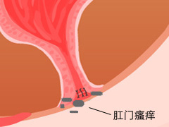 福州肛肠医院 福州医博肛肠医院 福州看痔疮的医院 福州肛瘘医院 福州肛裂医院 福州肠炎医院