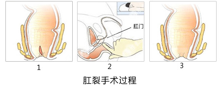 福州肛肠医院 福州医博肛肠医院 福州看痔疮的医院 福州肛瘘医院 福州肛裂医院 福州肠炎医院