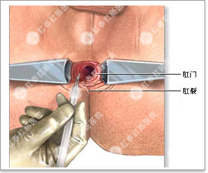 福州肛肠医院 福州医博肛肠医院 福州看痔疮的医院 福州肛瘘医院 福州肛裂医院 福州肠炎医院