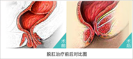 福州肛肠医院 福州医博肛肠医院 福州看痔疮的医院 福州肛瘘医院 福州肛裂医院 福州肠炎医院