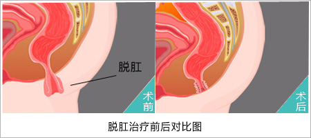 福州肛肠医院 福州医博肛肠医院 福州看痔疮的医院 福州肛瘘医院 福州肛裂医院 福州肠炎医院