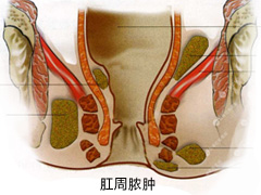 福州肛肠医院 福州医博肛肠医院 福州看痔疮的医院 福州肛瘘医院 福州肛裂医院 福州肠炎医院