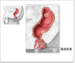 福州肛肠医院 福州医博肛肠医院 福州看痔疮的医院 福州肛瘘医院 福州肛裂医院 福州肠炎医院