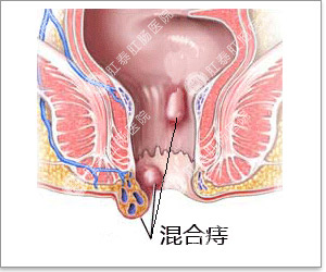 福州肛肠医院 福州医博肛肠医院 福州看痔疮的医院 福州肛瘘医院 福州肛裂医院 福州肠炎医院