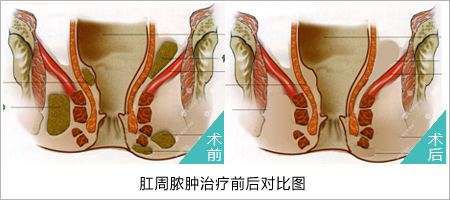 福州肛肠医院 福州医博肛肠医院 福州看痔疮的医院 福州肛瘘医院 福州肛裂医院 福州肠炎医院