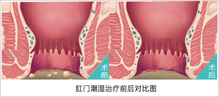 福州肛肠医院 福州医博肛肠医院 福州看痔疮的医院 福州肛瘘医院 福州肛裂医院 福州肠炎医院