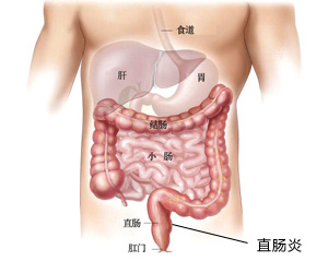 福州肛肠医院 福州医博肛肠医院 福州看痔疮的医院 福州肛瘘医院 福州肛裂医院 福州肠炎医院