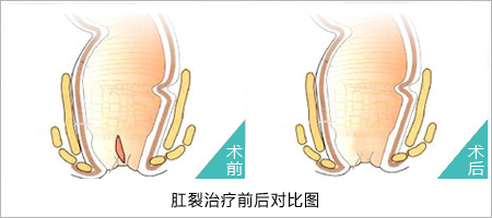 福州肛肠医院 福州医博肛肠医院 福州看痔疮的医院 福州肛瘘医院 福州肛裂医院 福州肠炎医院