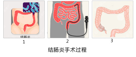 福州肛肠医院 福州医博肛肠医院 福州看痔疮的医院 福州肛瘘医院 福州肛裂医院 福州肠炎医院