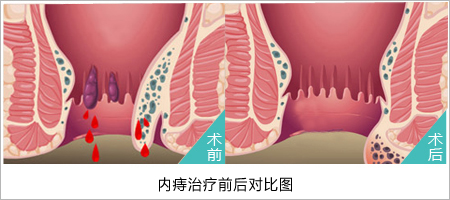 福州肛肠医院 福州医博肛肠医院 福州看痔疮的医院 福州肛瘘医院 福州肛裂医院 福州肠炎医院