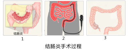 福州肛肠医院 福州医博肛肠医院 福州看痔疮的医院 福州肛瘘医院 福州肛裂医院 福州肠炎医院