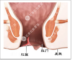 福州肛肠医院 福州医博肛肠医院 福州看痔疮的医院 福州肛瘘医院 福州肛裂医院 福州肠炎医院