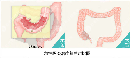 福州肛肠医院 福州医博肛肠医院 福州看痔疮的医院 福州肛瘘医院 福州肛裂医院 福州肠炎医院