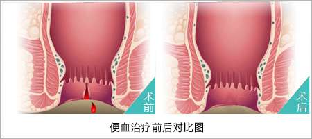 福州肛肠医院 福州医博肛肠医院 福州看痔疮的医院 福州肛瘘医院 福州肛裂医院 福州肠炎医院