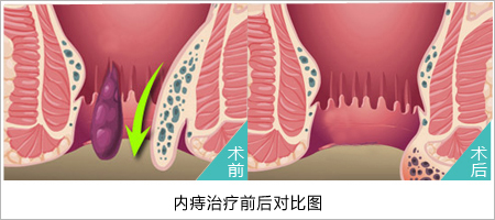 福州肛肠医院 福州医博肛肠医院 福州看痔疮的医院 福州肛瘘医院 福州肛裂医院 福州肠炎医院