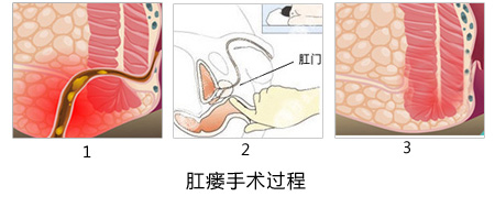 福州肛肠医院