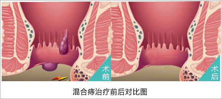 福州肛肠医院 福州医博肛肠医院 福州看痔疮的医院 福州肛瘘医院 福州肛裂医院 福州肠炎医院