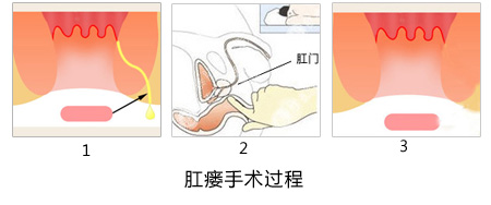 福州肛肠医院