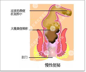 福州肛肠医院 福州医博肛肠医院 福州看痔疮的医院 福州肛瘘医院 福州肛裂医院 福州肠炎医院