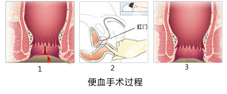 福州肛肠医院