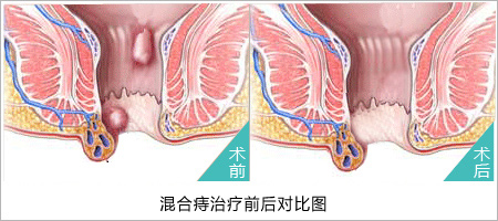 福州肛肠医院 福州医博肛肠医院 福州看痔疮的医院 福州肛瘘医院 福州肛裂医院 福州肠炎医院